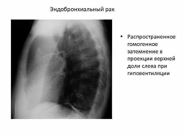 Затемнение верхней доли легкого. Гиповентиляция верхней доли рентген. Гомогенное затемнение верхней доли правого легкого. Гиповентиляция верхней доли правого легкого рентген. Гиповентиляция верхней доли правого легкого.