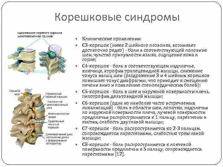 Корешковое поражение. Шейный корешковый синдром. Корешок с1 поясничного отдела позвоночника. Корешковый синдром поясничного крестцового отдела. Корешковый синдром грудного отдела.