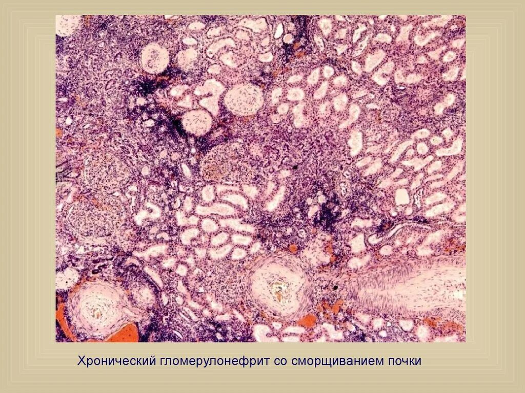 Подострый гломерулонефрит. Гломерулонефрит патанатомия. острый гломерулонефрит патанатомия. хронический гломерулонефрит микропрепарат. хронический гломерулонефрит микропрепарат патанатомия.