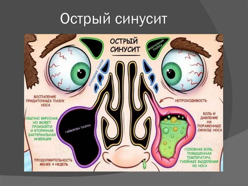 Гнойный насморк у взрослых. Хронический синусит клинические рекомендации. Полипозный синусит патогенез. Острые и хронические синуситы. Причины синусита у взрослых.