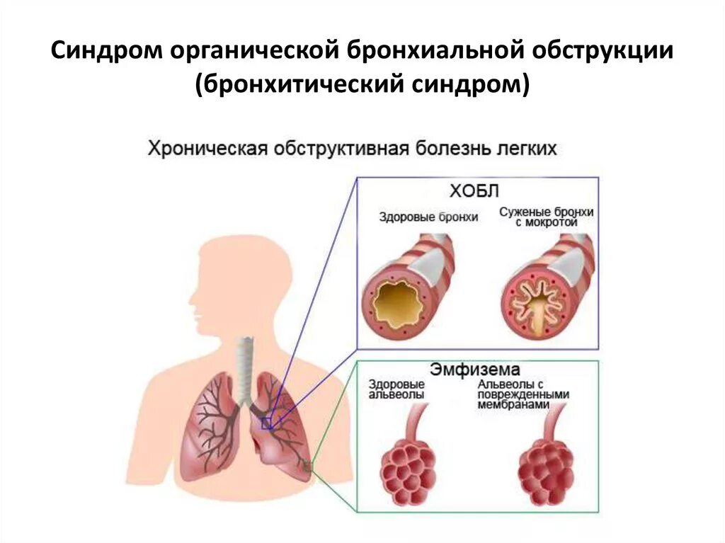 Хроническим заболеванием дыхательных. Для хронической обструктивной болезни лёгких характерно. Бронхиальная обструкция у ХОБЛ. При хронической обструктивной болезни легких. Бронхиальная обструкция при хоб.