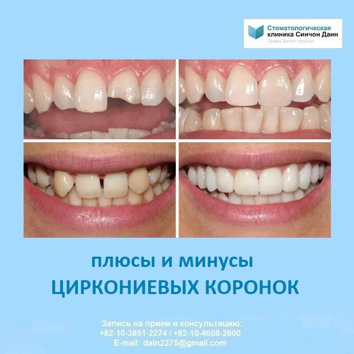 Цирконий зубы плюсы и минусы. Диоксид циркониевая коронка. металлокерамика коронка цирконий. диоксид циркония коронки или металлокерамика. металлокерамическая коронка и циркониевая коронка.