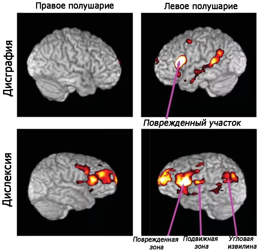 Дцп мозг. Поражение зон мозга при ДЦП. «Дислексия и дисграфия при поражениях головного мозга».. Зоны поражения мозга при дислексии. Нарушение мозга при дислексии.