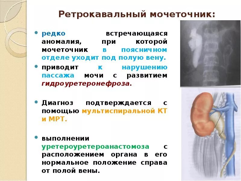 Врожденные дефекты мочевыделительной системы. Пороки развития мочевыделительной системы. Аномалии развития мочевыводящей системы. Пороки развития выделительной системы.