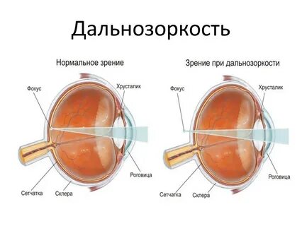 Миопия лечение отзывы