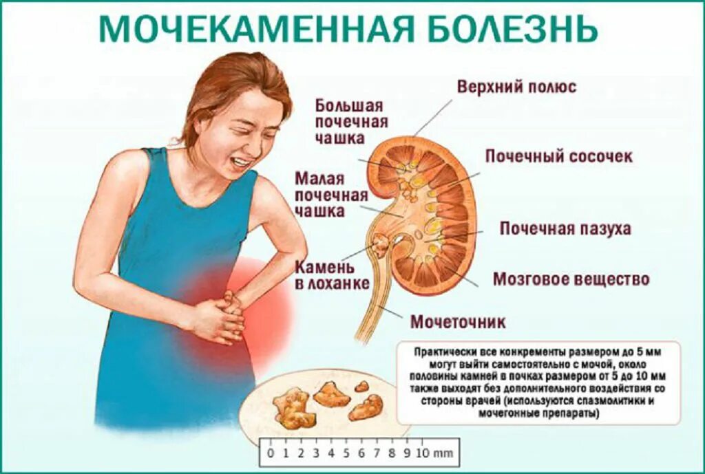 Мочекаменная болезнь картинки. Шиповник при почках. Почечнокаменная болезнь.