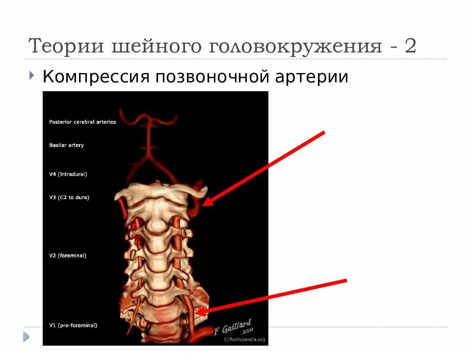 Интракраниальный сегмент позвоночной артерии. V3 сегмент позвоночной артерии. Шейный синдром позвоночной артерии. Позвоночная артерия сегменты анатомия.