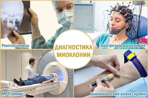 Кортикальная миоклония