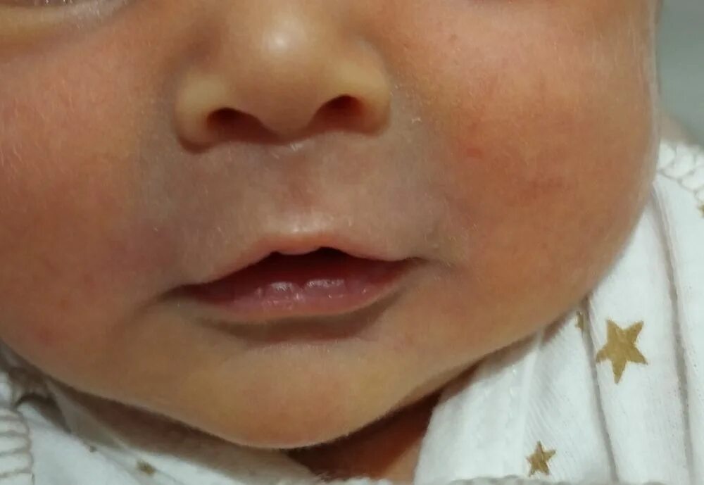 Синеет вокруг рта. Синюшность на подбородке у ребенка. Синюшность носогубного треугольника. Носогубный треугольник у новорожденного. Синяя носогубная у новорожденного.