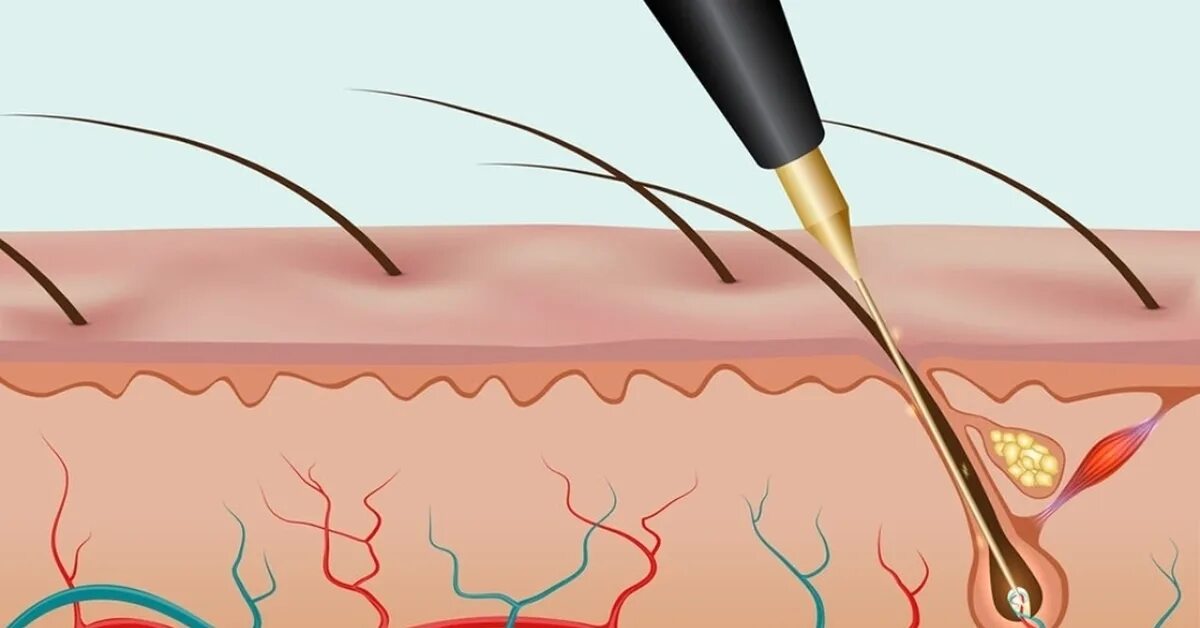 Флеш термолиз электроэпиляция. Электро лазерная эпиляция. Как делают электроэпиляцию. Электроэпиляция волос. Электро депиляция.