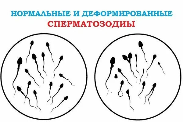 Норма вязкости эякулята. Тератозооспермия что это такое у мужчин причины. Тератозооспермия что это такое у мужчин причины. Тератозооспермия спермограмма. Тератозооспермия что это такое у мужчин причины.
