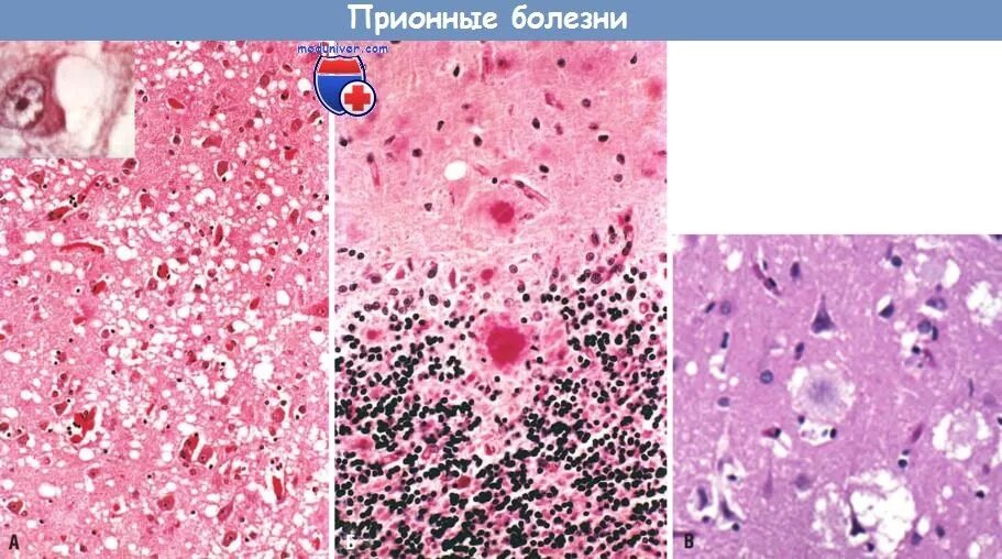 Больные куру. Болезни Крейтцфельдта-Якоба микропрепарат. Прионные болезни гистология. Болезнь Крейтцфельдта-Якоба.