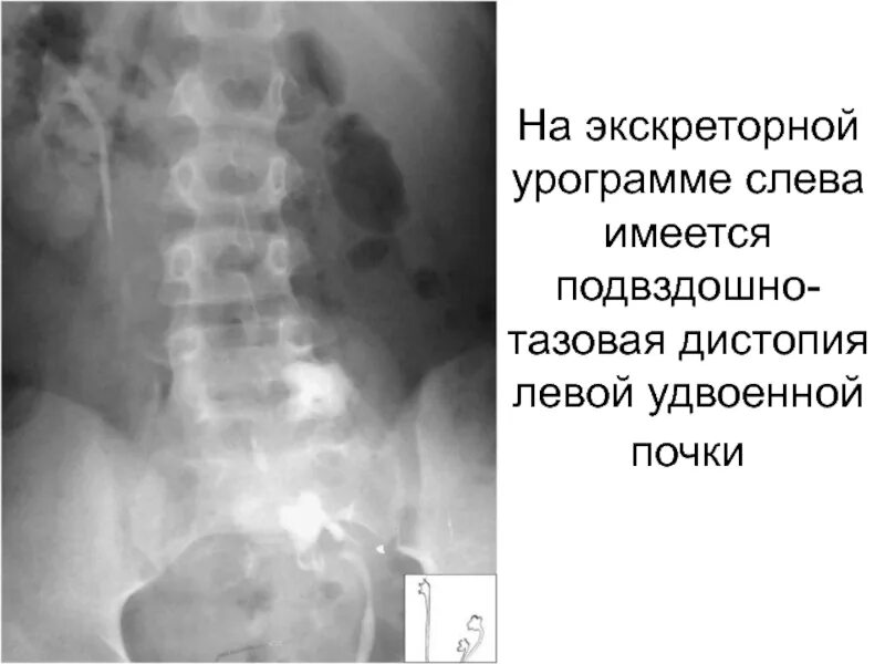 Перегиб мочеточника. Тазовая дистопия почки рентген. Перегиб мочеточника рентген. Поясничная дистопия почки рентген. Дистопия почки рентген.