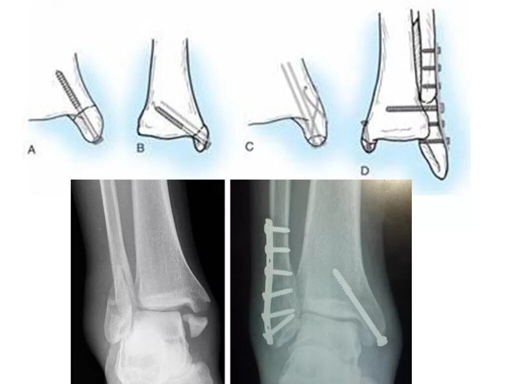 Перелом лодыжки форум вумен. Перелом лодыжки с остеосинтезом. Подсиндесмозный перелом лодыжки. Абдукционный перелом лодыжки. Супинационный перелом лодыжки.