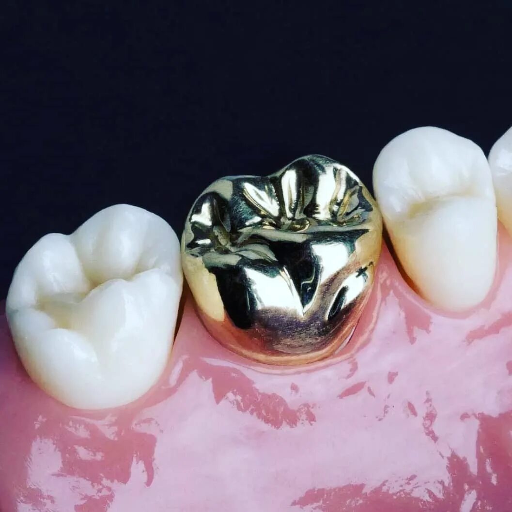 цельнолитая коронка (кхс с напылением). коронки на зубы пенза. вкладка из циркония диоксида циркония. внутрикорневая культевая вкладка. металлокерамическая коронка ivoclar.