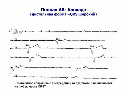 Экг полная