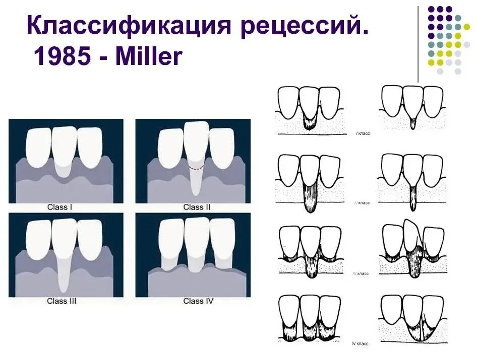 Исправляем форму десен. Классификация Миллера рецессии десны. Классификация рецессии десны по Миллеру. Рецессия классификация Миллера. Классификация рецессий по Miller.