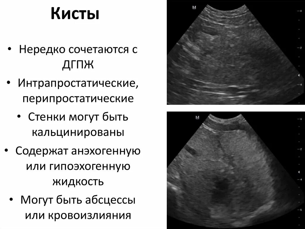 У мужчина киста будет. Киста маточки предстательной железы УЗИ. Кисты предстательной железы эхограммы.