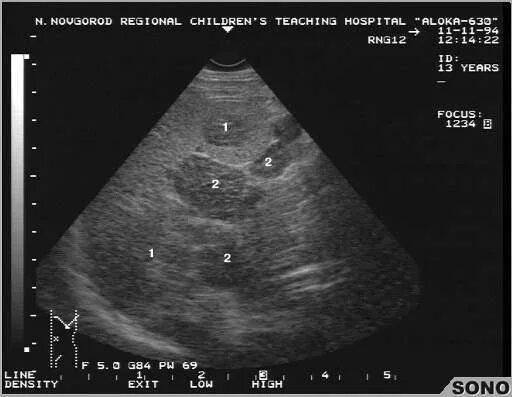 УЗИ селезенки при лейкозе. Патология селезенки на УЗИ. Гемангиосаркома селезенки УЗИ.