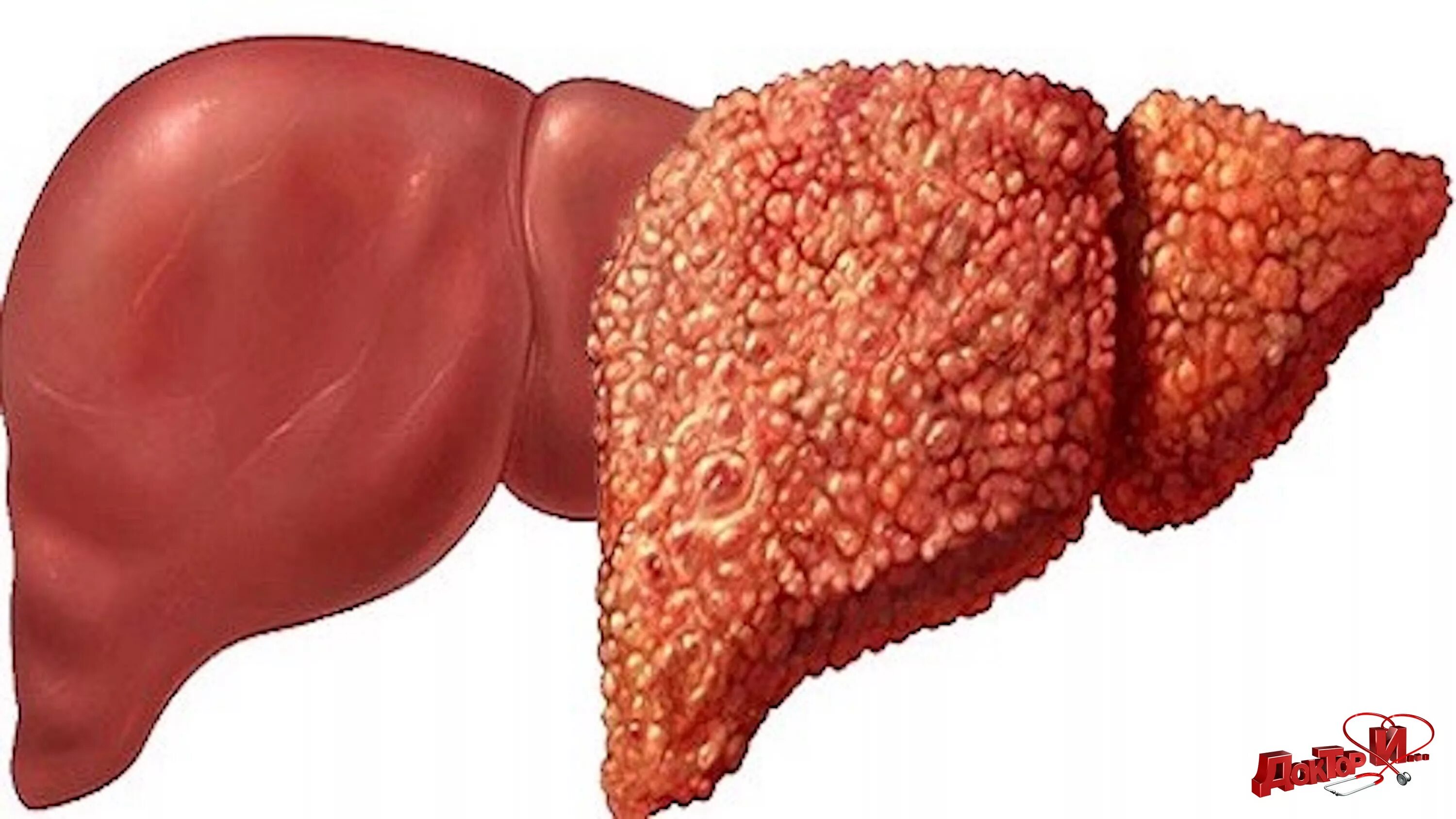 Ком в печени. Jirovoi gitapoz pecheni. Гепатоз жировой гепатоз. Тиреотоксический гепатоз. Печеночный жировой гепатоз.