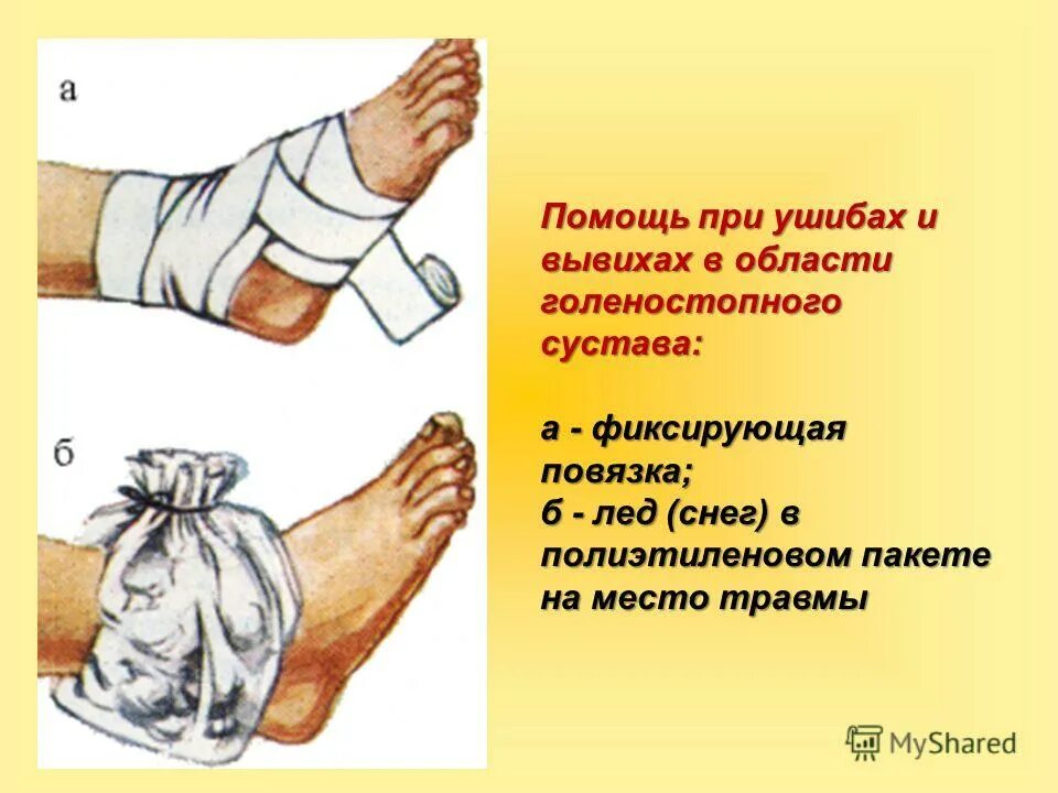 Растяжение презентация. Помощь при ушибах и растяжении связок. Алгоритм оказания первой помощи при ушибах, вывихах и переломах. Оказание 1 помощи при растяжении и разрыве связок. Помощь при ушибах и растяжении связок.