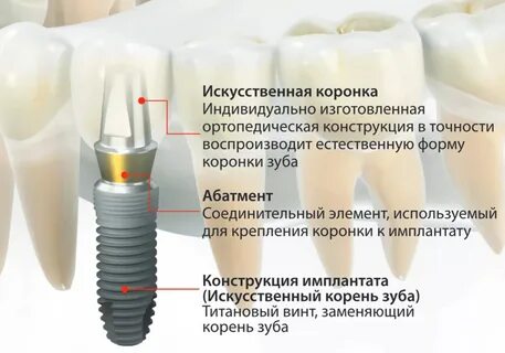 Где вставить импланты зубы