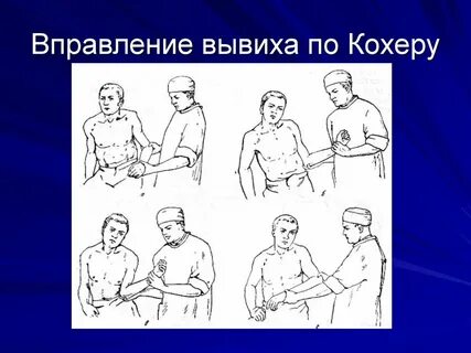 Вправление вывиха