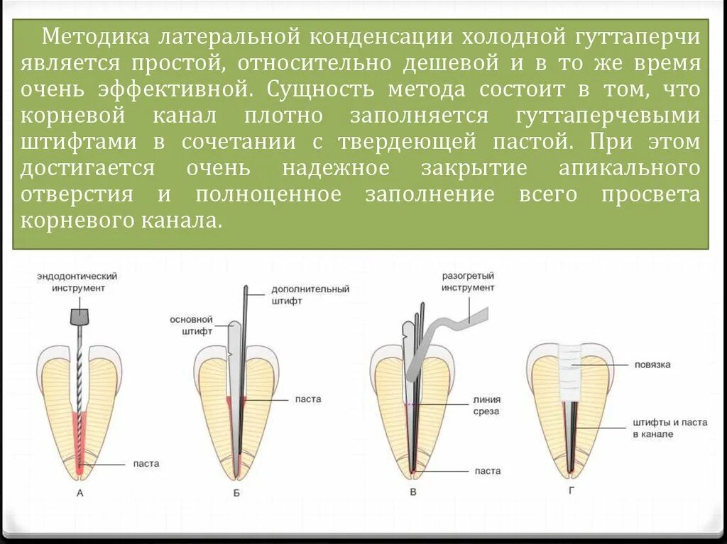 Гуттаперч вый опрометч вость. Метод латеральной конденсации для пломбирования корневых каналов. Пломбирование корневых каналов гуттаперчей латеральная конденсация. Пломбирование корневых каналов методом горячей гуттаперчи. Обтурация корневых каналов методом латеральной конденсации.