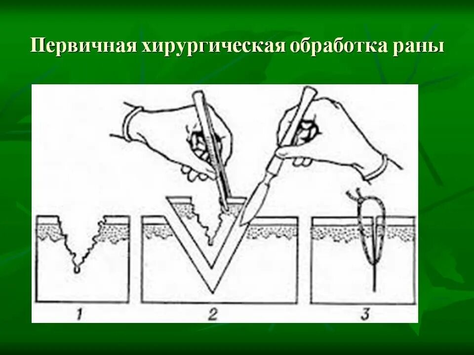 Пхо раны. Первичная хирургическая обработка раны. Первичной хирургический отработка РАН. Схема первичной хирургической обработки раны.