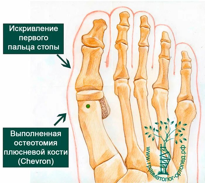 Основные фаланги стопы. Головка 1 плюсневой кости левой. Остеотомия головки плюсневой кости. Остеохондропатия головки 2 плюсневой кости. Деформация головок плюсневых костей стопы.