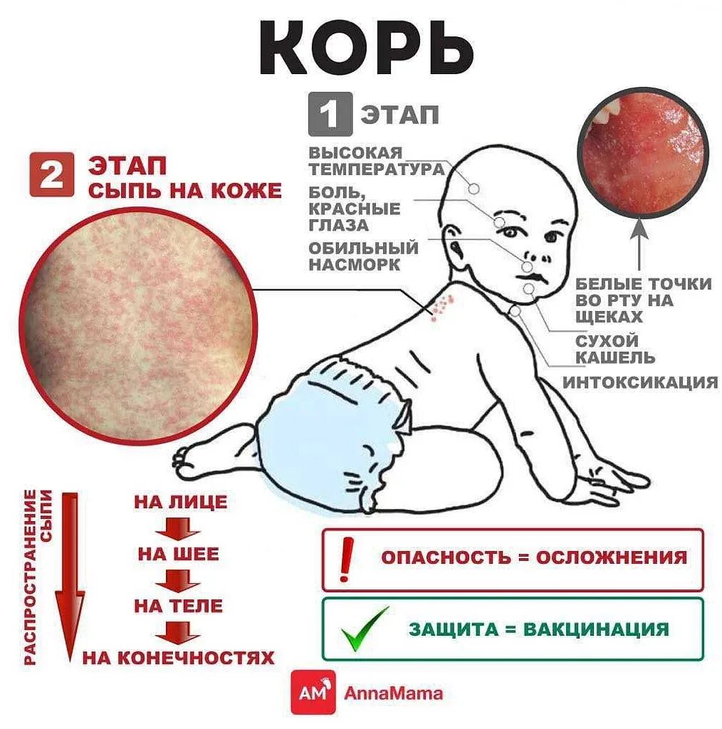 Как проявляется корь
