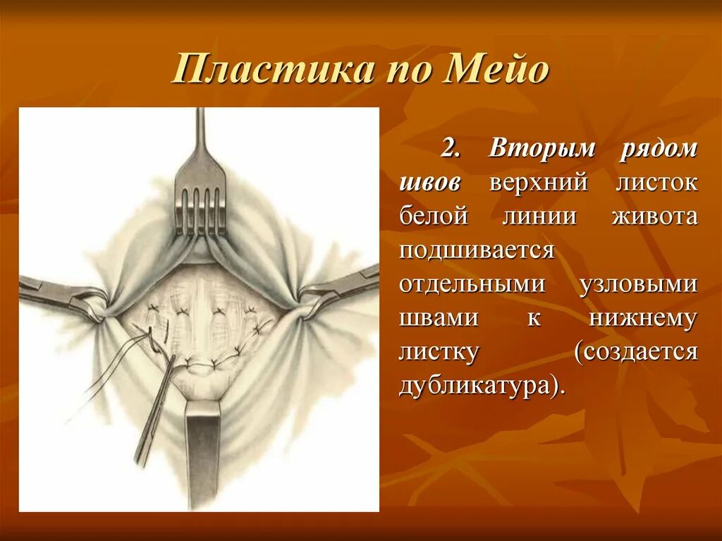 Пупочная грыжа по мейо. Аутодермопластика кожный лоскут. Способ жирара спасокукоцкого со швом кимбаровского. Паховая грыжа пластика по лихтенштейну. Z-образная кожная пластика по лимбергу.