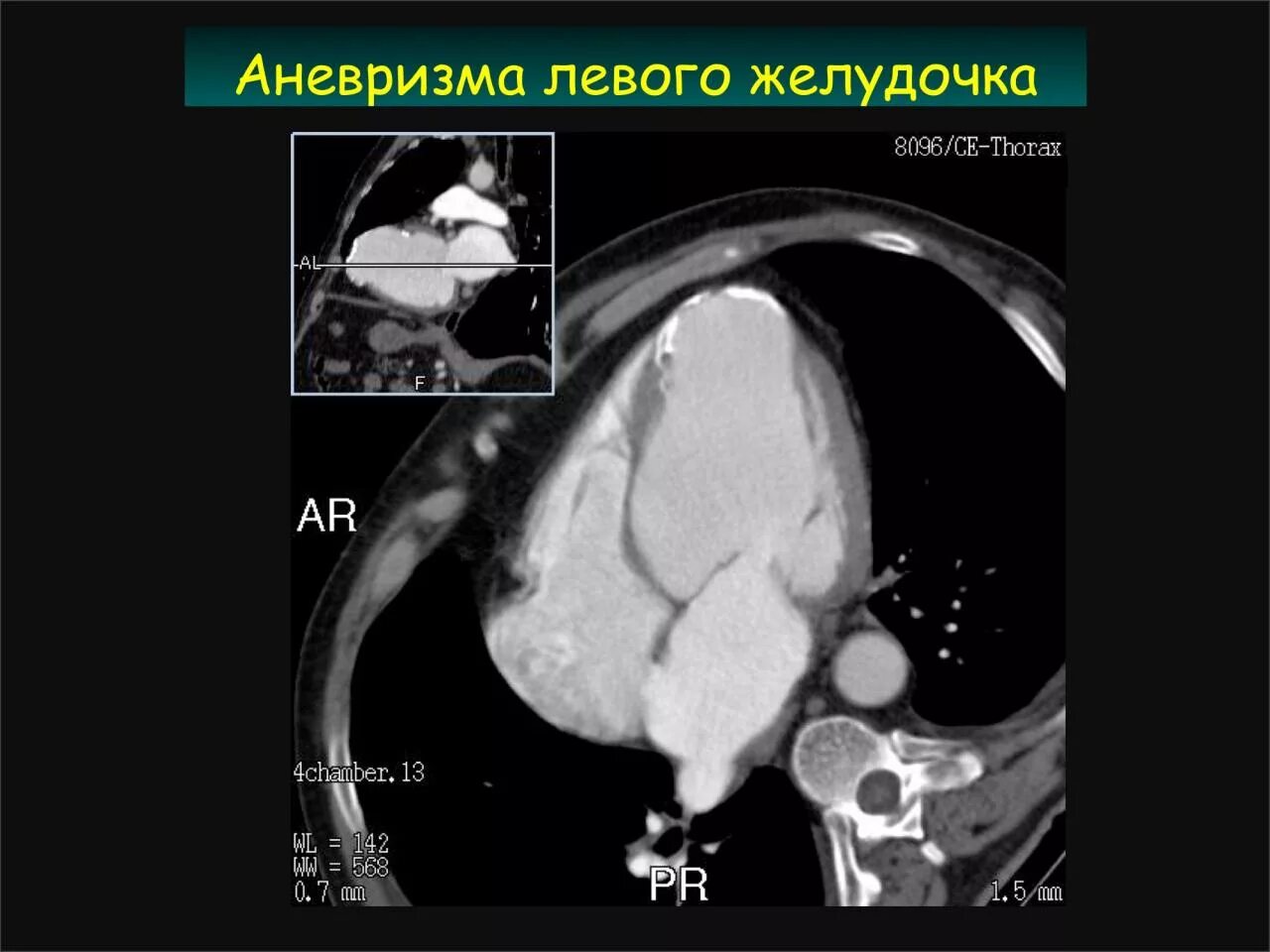 Тромб в желудочке. Аневризма левого желудочка мрт. Аневризма левого желудочка на кт. Аневризма левого желудочка сердца кт.