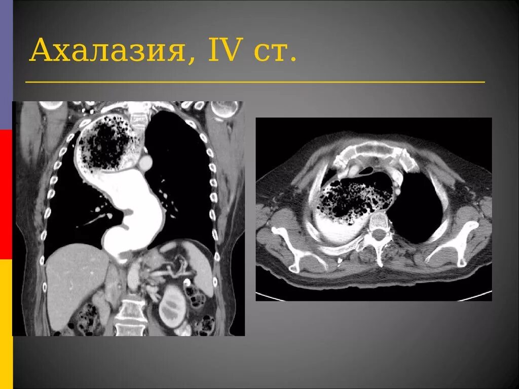 Халазия пищевода. Ахалазия кардии пищевода кт.