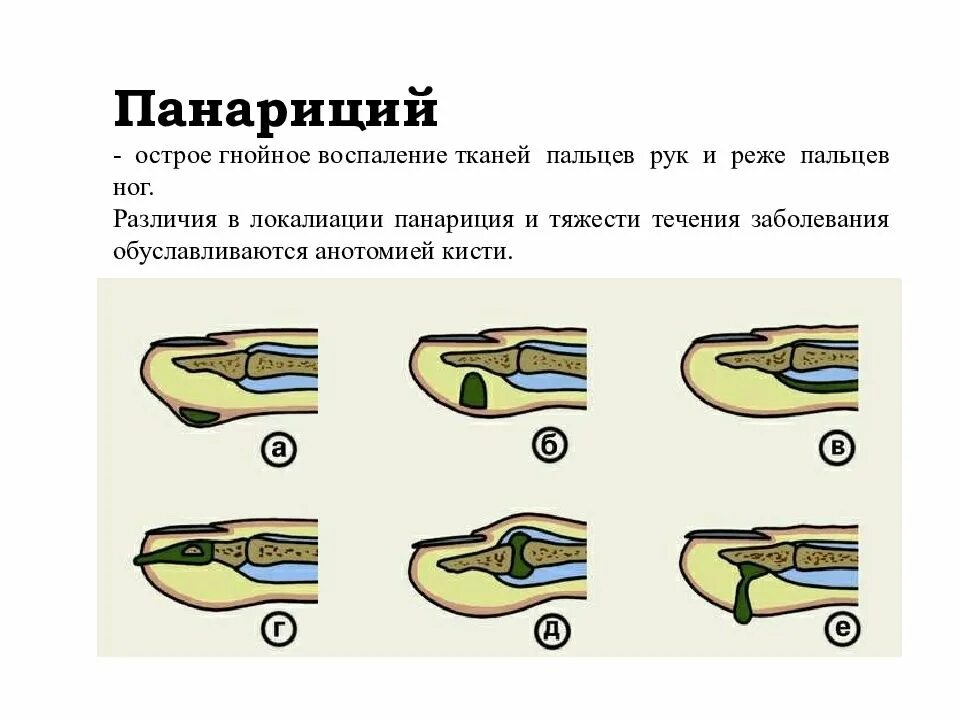 Мазь от панариция с антибиотиком. Мазь от панариция с антибиотиком. Панариций мазь отзывы. Околоногтевой панариций вскрытие. Панариций мазь отзывы.