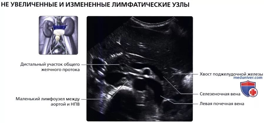 Парааортальные лимфоузлы брюшной полости. Мезентериальные лимфатические узлы в брюшной полости УЗИ. Лимфоузлы забрюшинного пространства на УЗИ. Мезентериальные лимфоузлы на УЗИ брюшной полости. Подвздошная лимфаденопатия