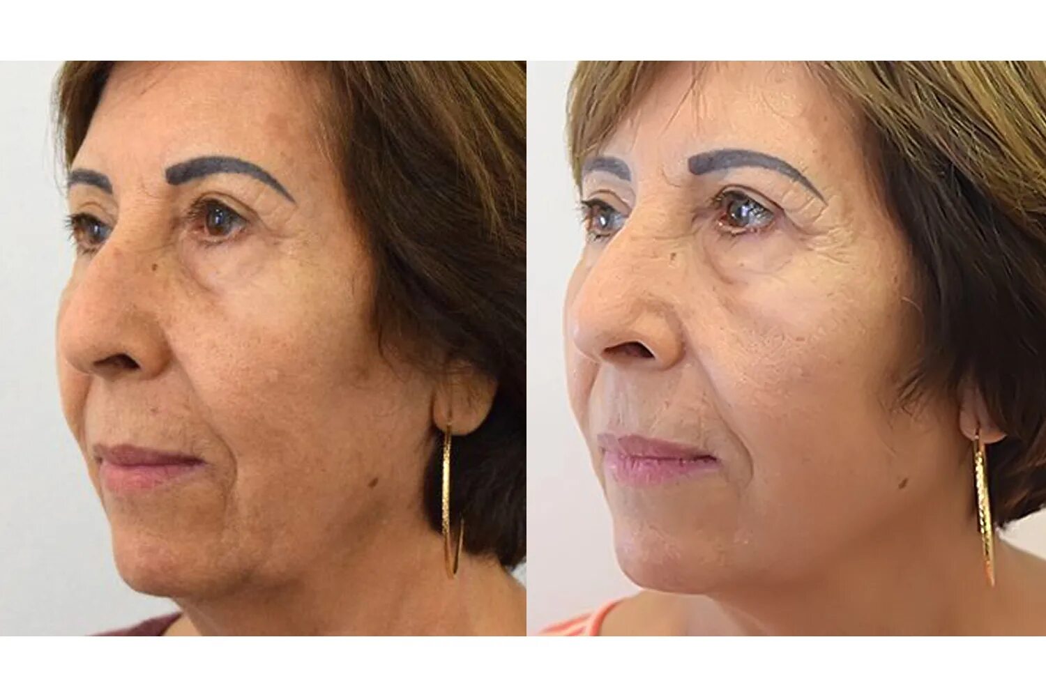 Ультраформер 3 смас аппарат. Смас лифтинг ультраформер. Ультраформер лифтинг. Ультраформер до и после лицо. Смас лифтинг ультраформер.