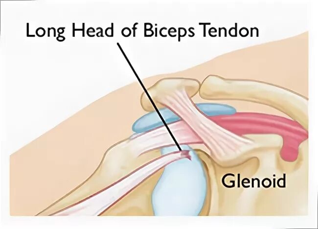 Сухожилие длинной головки двуглавой мышцы плеча. Отрыв сухожилия двуглавой мышцы. Тендинит сухожилия бицепса плечевого сустава. Тендовагинит сухожилия двуглавой мышцы.