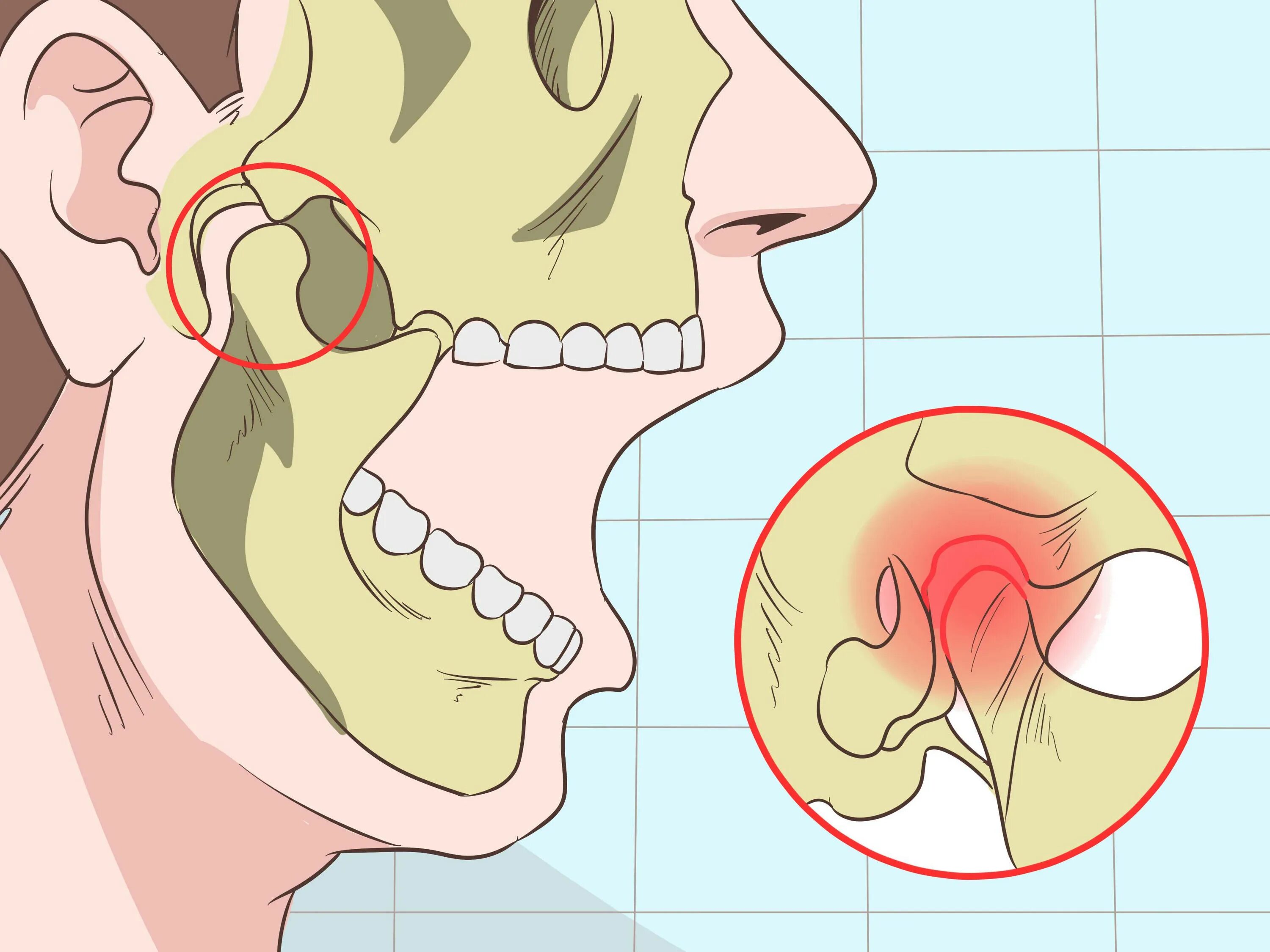 Из за чего может болеть челюсть. Вывих височно-нижнечелюстного сочленения (вывих нижней челюсти). Вывихи и подвывихи челюсти. Подвывих сустава челюсти.