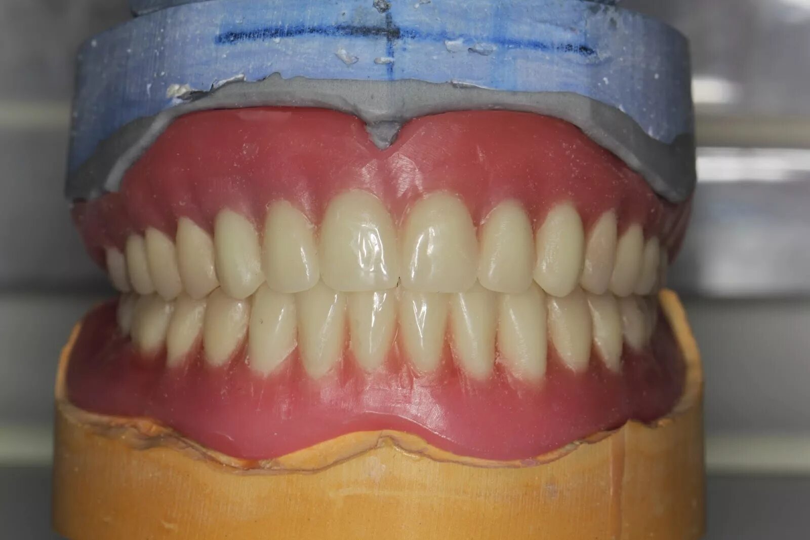 Искусственные зубы. Пластмассовые зубы для съемных протезов. Зубные протезы верхней челюсти. Полный съемный пластиночный протез. Постановка зубов на нижнюю челюсть.