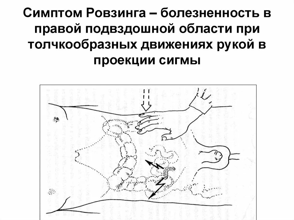 Щеткина блюмберга при аппендиците. Симптомы Ровзинга Ситковского Воскресенского аппендицита. Симптомы Щеткина Блюмберга Ровзинга. Острый аппендицит симптом Щеткина. Симптом Ситковского острого аппендицита.