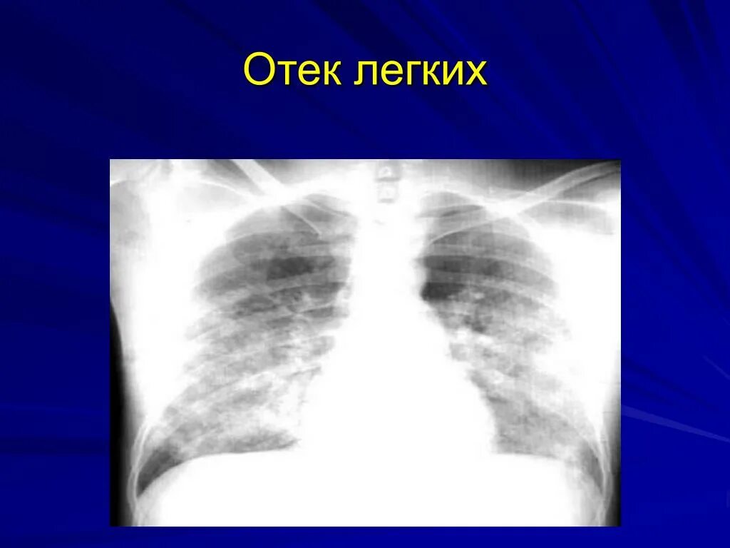 Отёк легкого на рентгенограмме. Отек легкого на рентгенограмме. Альвеолярный отек легких рентген. Отек легких рентген. Застойные изменения в легких