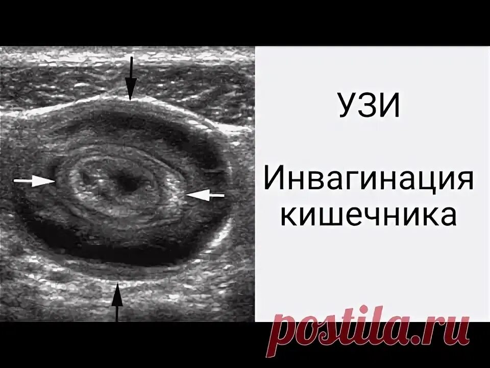 Узи кишок что это. Кишечник на узи брюшной полости. Расширение петель кишечника узи. Эвентрация кишечника на узи. Инвагинация кишки ультрасонография.
