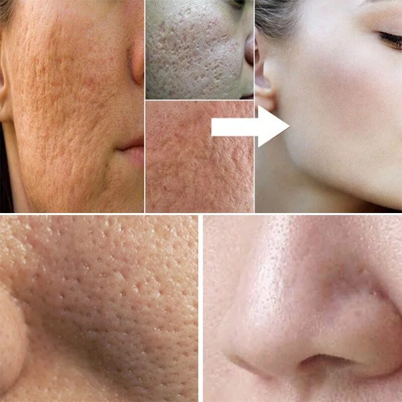 чистка лица. сыворотка для лица lanbena. гель для сужения пор пропеллер. сузить поры отзывы. средства для сужения пор на лице.