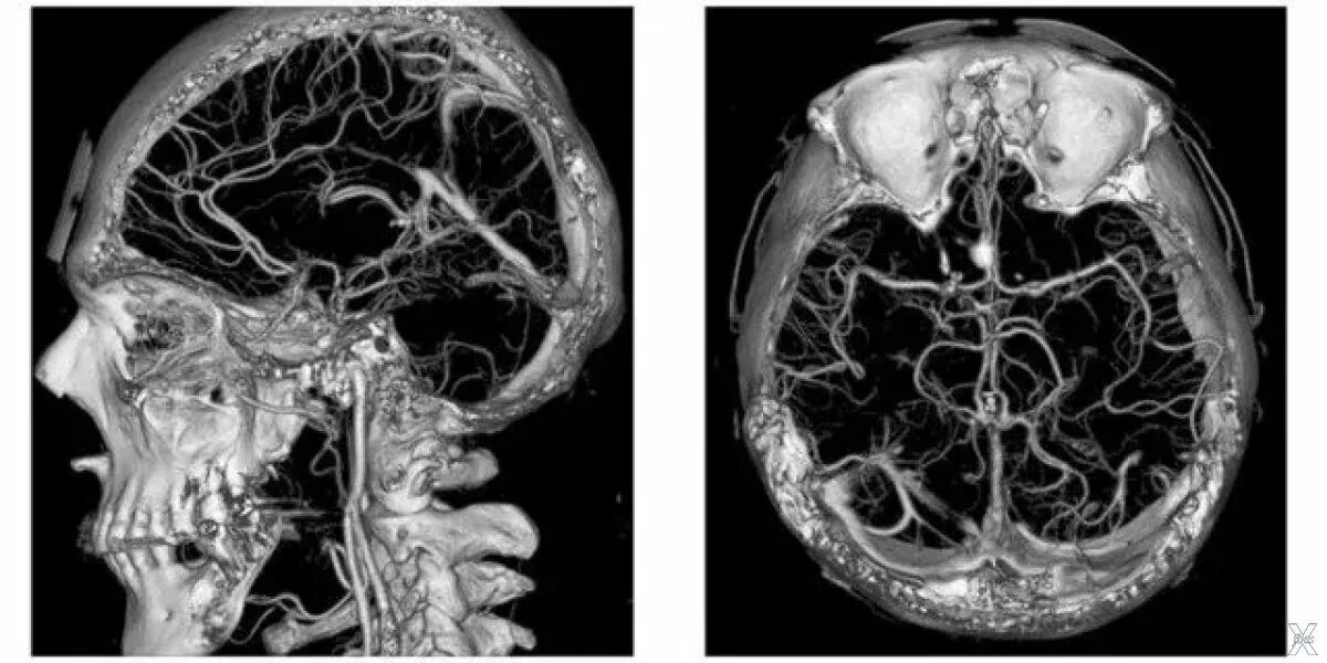 Кт ангиография сосудов головного мозга. Кт-ангиография артерий шеи и головного мозга. Кт ангиография аневризма. Кт ангиография церебральных сосудов головного мозга.