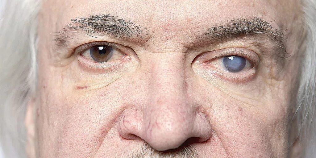 Незрячий взгляд. Глаза слипова человека. Белые глаза. Глаза слипова человека. Незрячий взгляд.