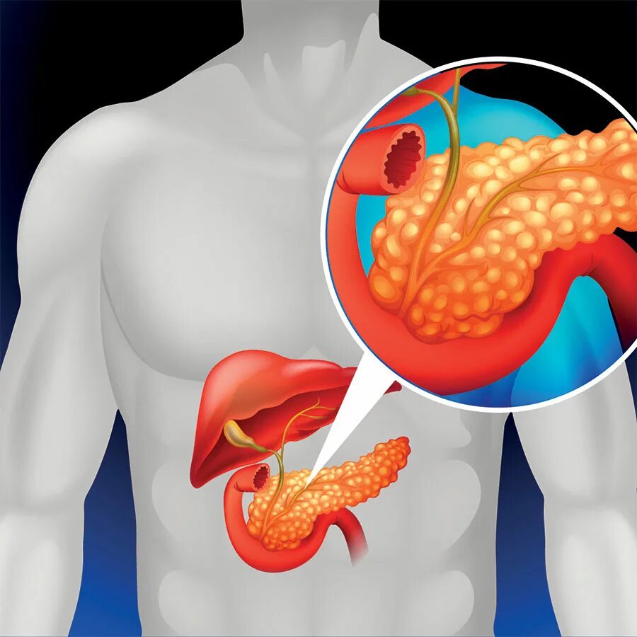 От чего появляется панкреатит. Панкреатит поджелудочной железы. Болезнь поджелудочной железы панкреатит. Хронический панкреатит. Острый билиарный панкреатит.
