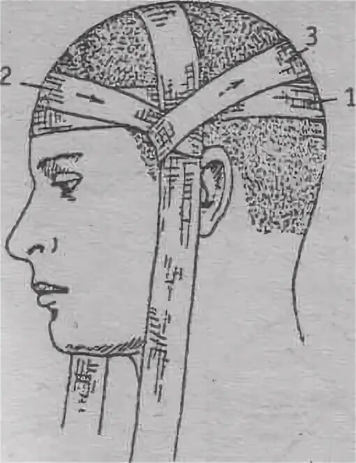 Техника наложения шапочки гиппократа. Повязка чепец техника наложения.