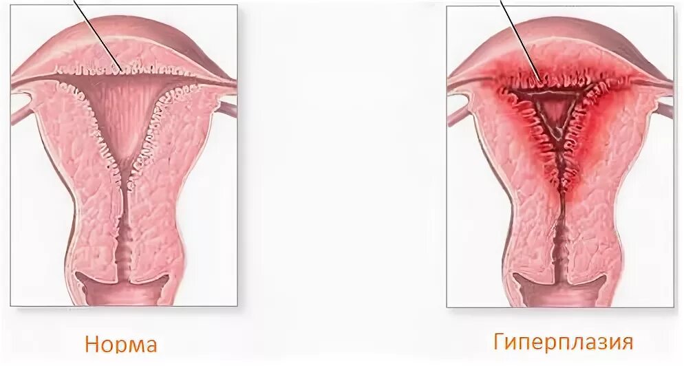 Ультраменструальная гиперплазия эндометрия что это. Гравидарная гиперплазия эндометрия. Эндометриоз гиперплазия матки. Железистая атипическая гиперплазия.