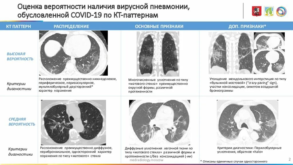 Может быть поражение легких. Ковид на кт вирусная пневмония. поражения легких при пневмонии кт. пневмония при ковиде кт. ковидная пневмония на кт.